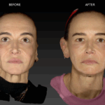 JULÄINE™ collagen biostimulator treatment at The Lovely Clinic, Chelsea London