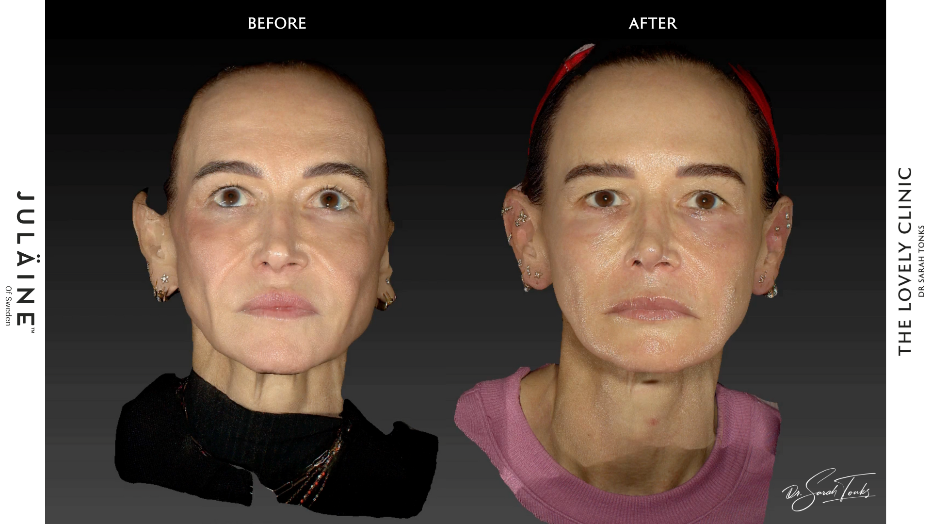 JULÄINE™ collagen biostimulator treatment at The Lovely Clinic, Chelsea London