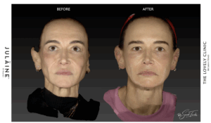 JULÄINE™ before and after 